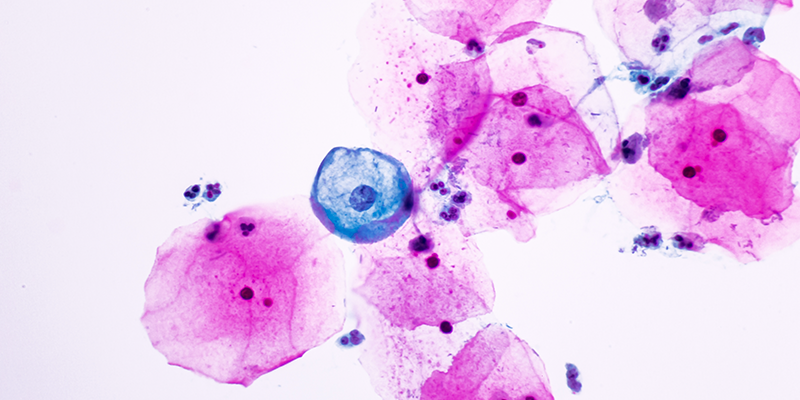 Variantes de alto riesgo de VPH