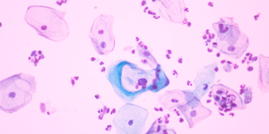 VPH no siempre es cáncer