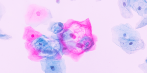 El Papanicolaou ayuda a detectar cambios anormales.